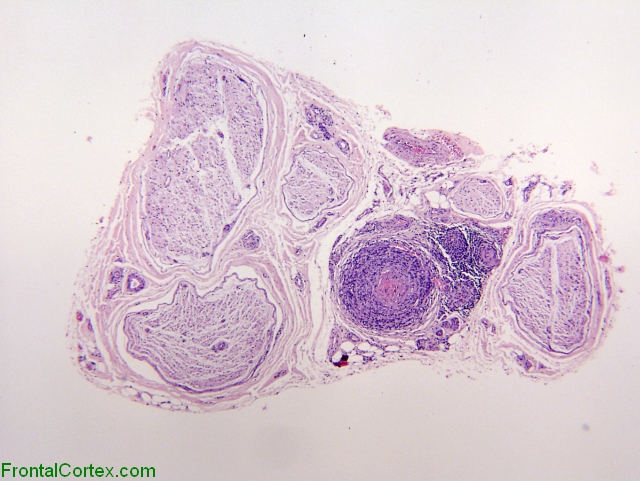 Necrotizing vasculitis involving epineurial blood vessels.